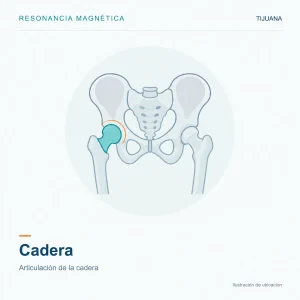 Resonancia Magnética Cadera