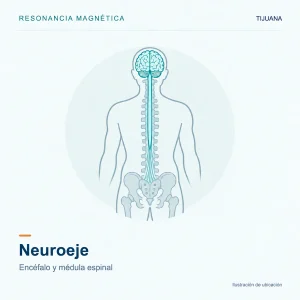 Resonancia Magnética Neuroeje